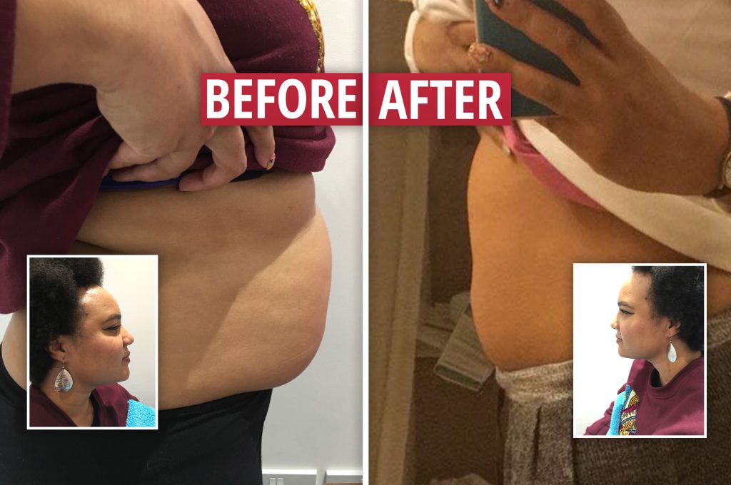 'Why go under the knife when you can do this?' We try out the latest celebrity cosmetic craze and receive SHOCKING results within a week