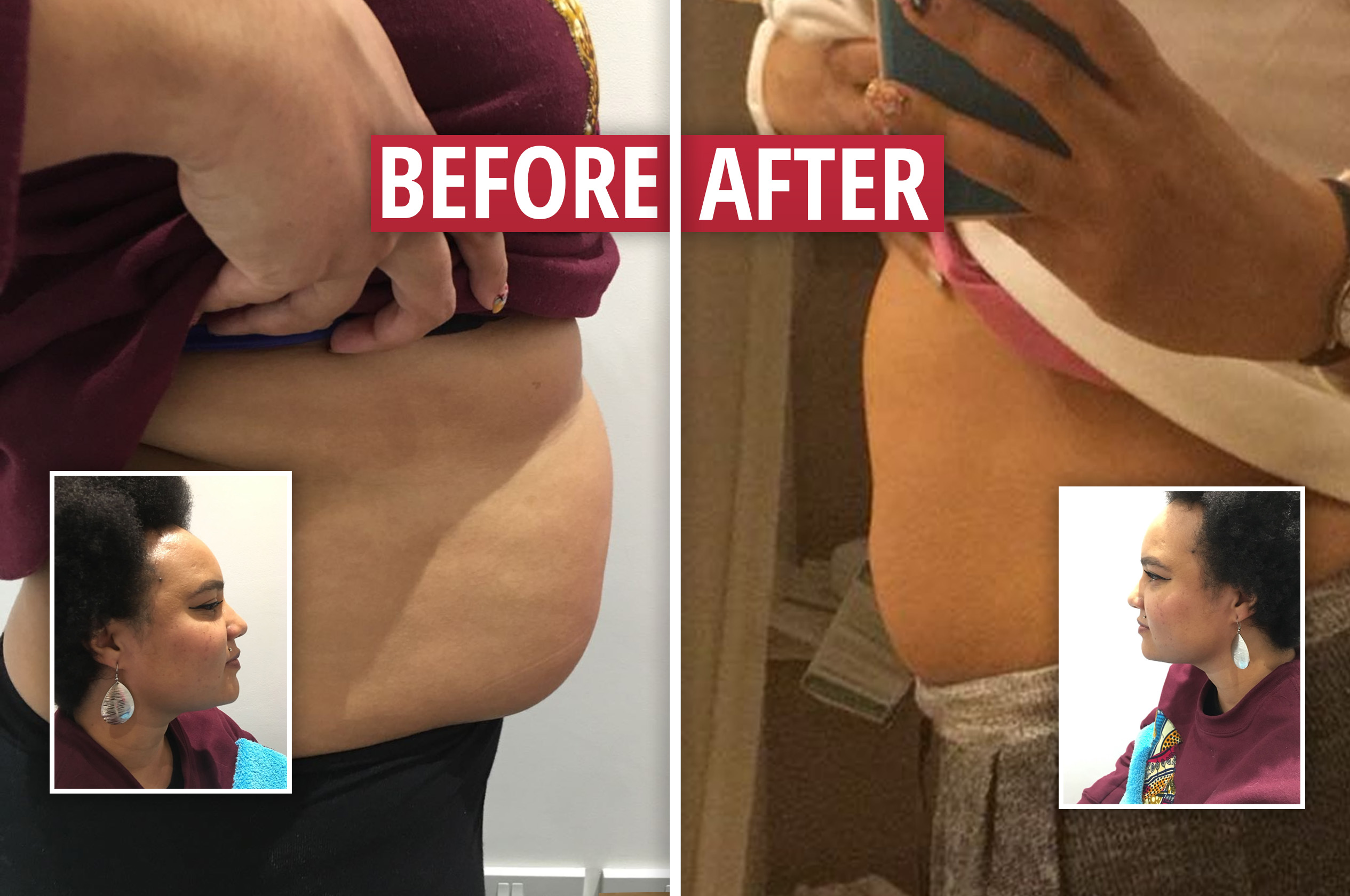 'Why go under the knife when you can do this?' We try out the latest celebrity cosmetic craze and receive SHOCKING results within a week